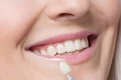  Kompozitne fasete. Akcija